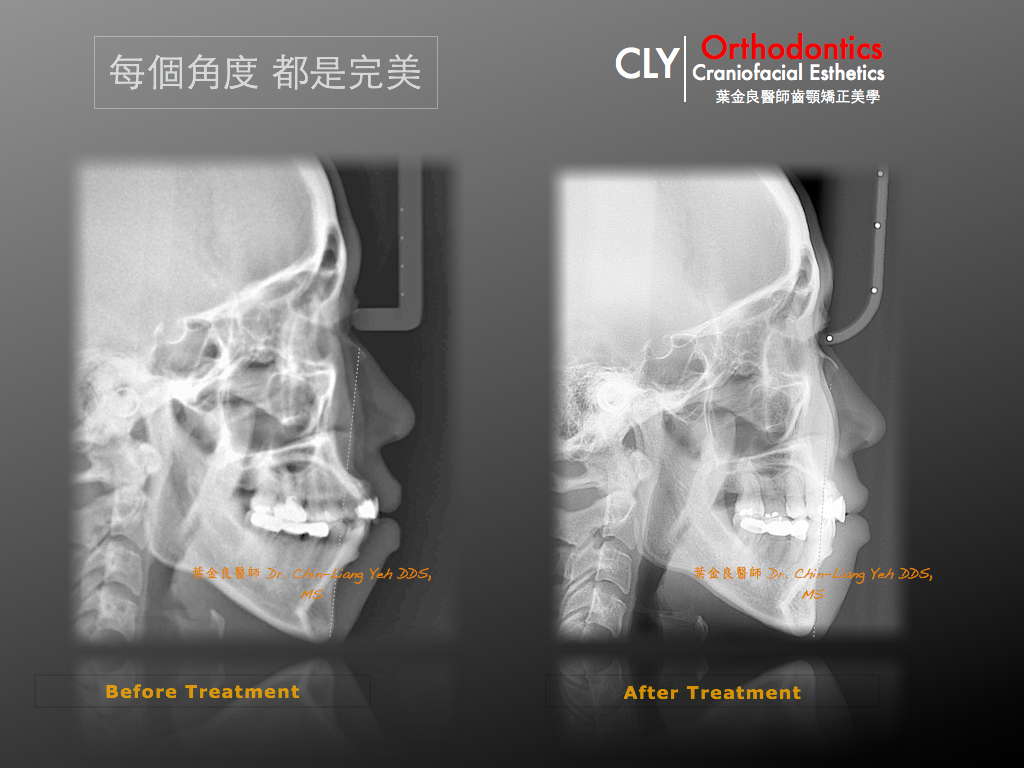 CLY Orthodontics Studio | 齊杏歯顎矯正專科:: 痞客邦::